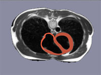 Herzmodell eingebettet in MR-Volumendaten